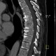 End plate disease, grade III, osteochondrosis, vacuum phenomenon: CT - Computed tomography